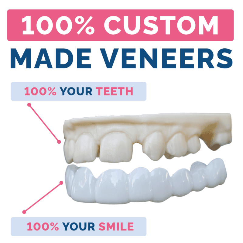 PDP 100 CUSTOM MADE VENEERS