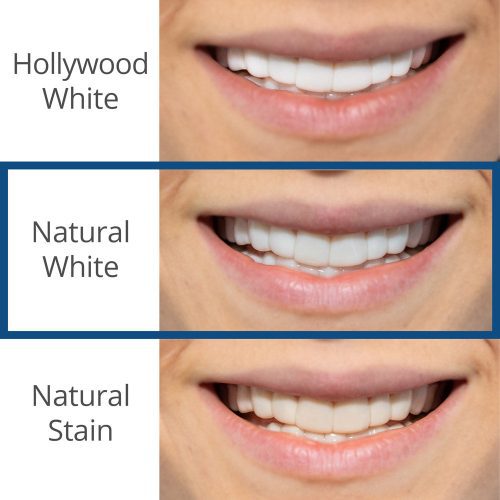 Spare Veneers